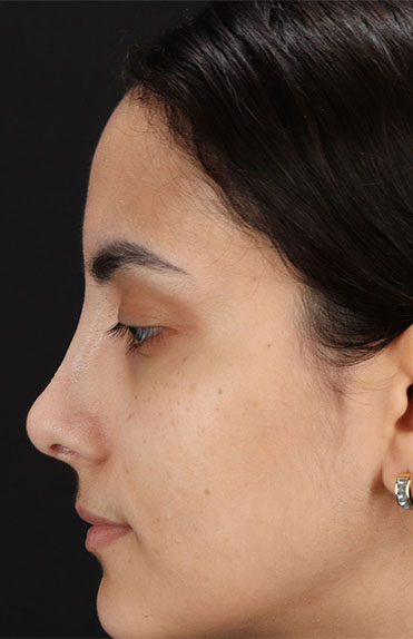 After - left_lateral