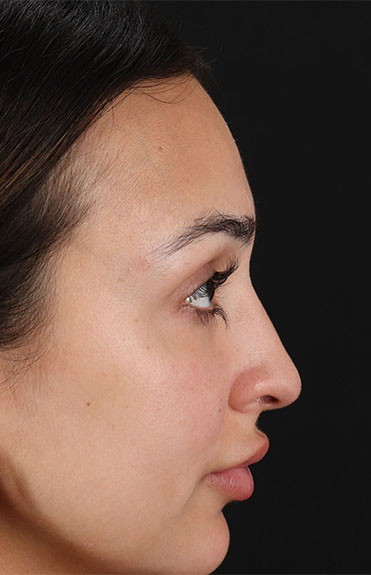 Before - right_lateral