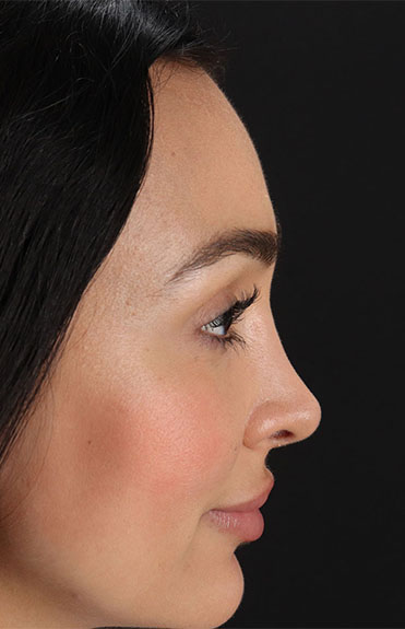 After - right_lateral