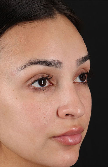 Before - right_oblique