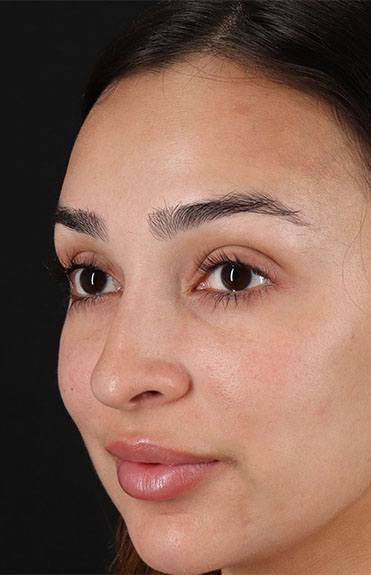 Before - left_oblique