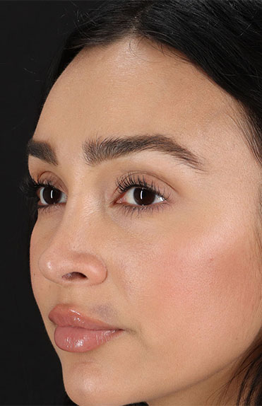 After - left_oblique