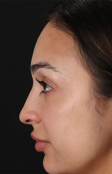 Before - left_lateral