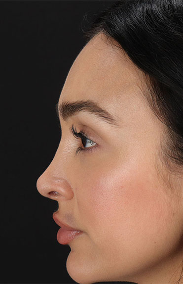 After - left_lateral