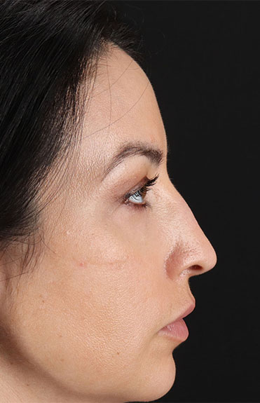 Before - right_lateral