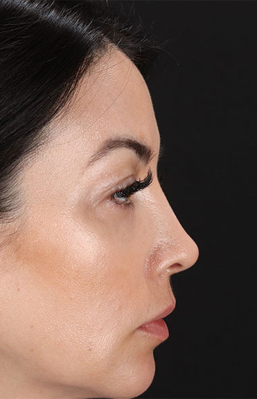 After - right_lateral