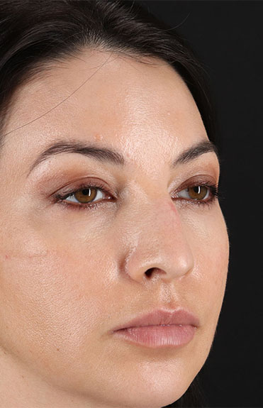 Before - right_oblique