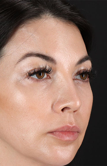 After - right_oblique