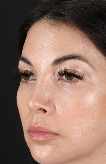 After - left_oblique