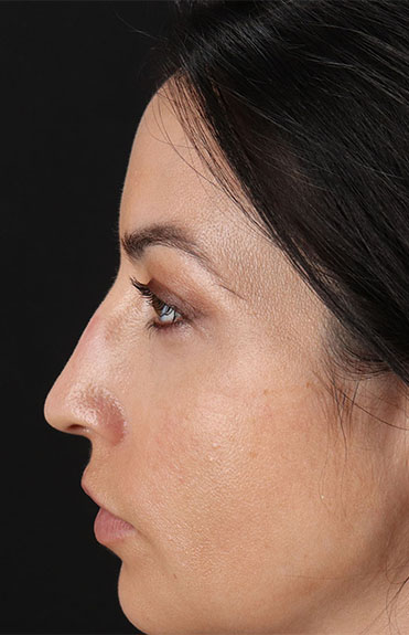 Before - left_lateral