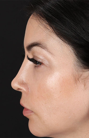 After - left_lateral