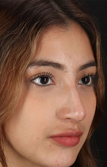 After - right_oblique