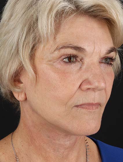 After - right_oblique