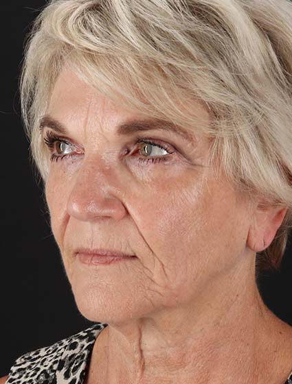 Before - left_oblique