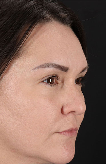 Before - right_oblique