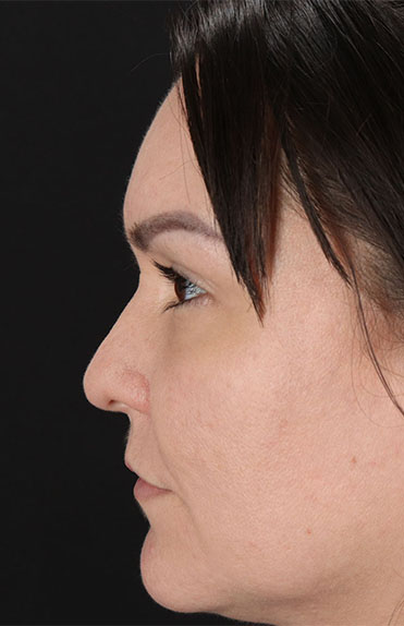 Before - left_lateral