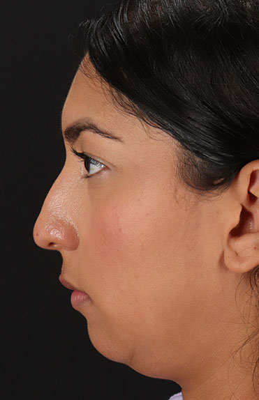 Before - left_lateral