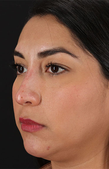 After - left_oblique