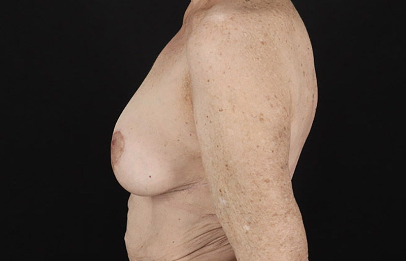 After - left_lateral