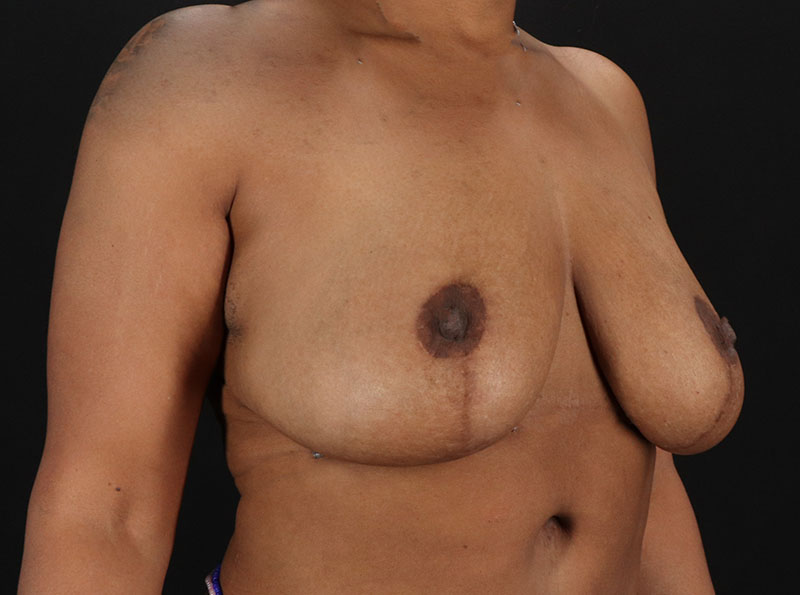 After - right_oblique