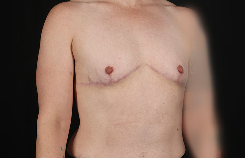 After - right_oblique