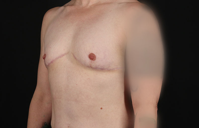 After - left_oblique