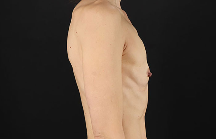 Before - right_lateral