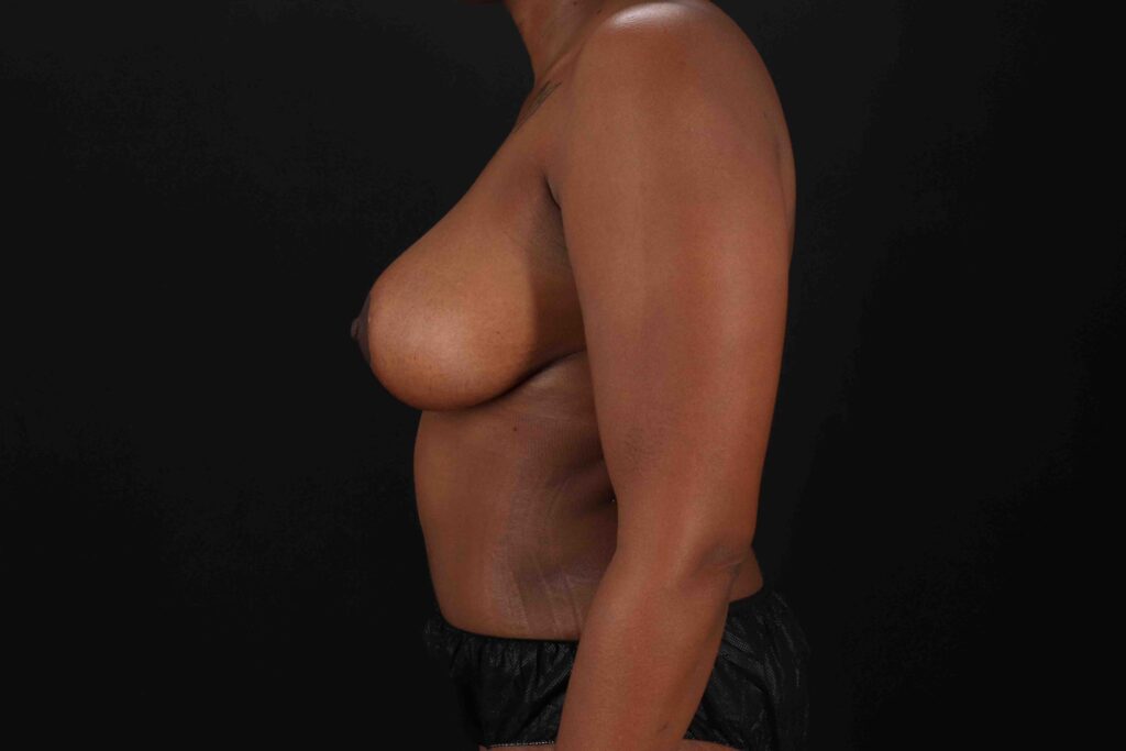 After - left_lateral