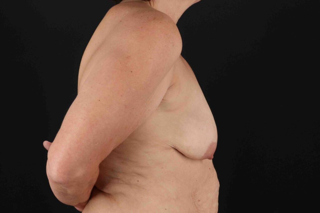 Before - right_lateral