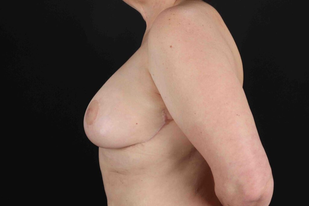 After - left_lateral