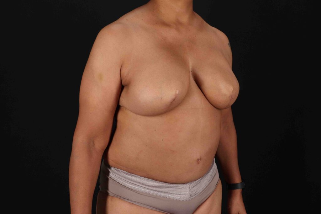 After - right_oblique