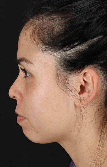 After - left_lateral