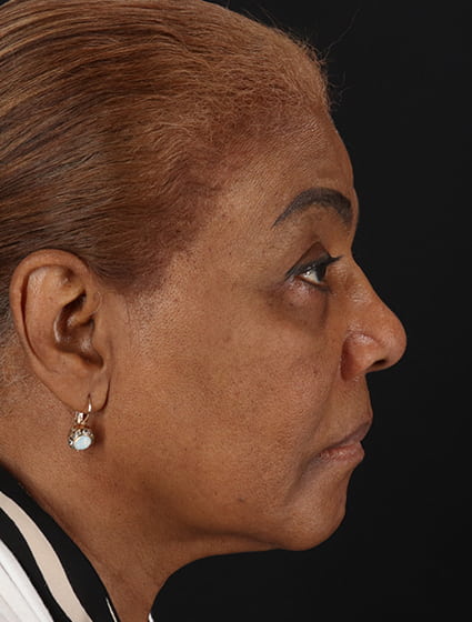 Before - right_lateral