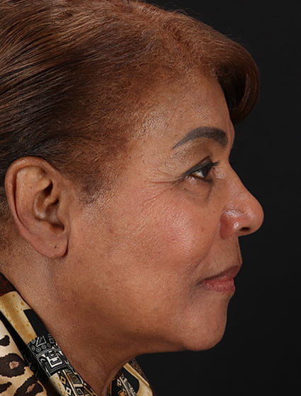 After - right_lateral