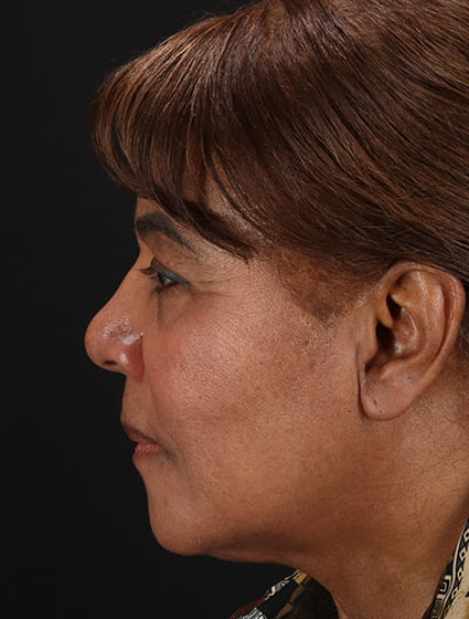 After - left_lateral