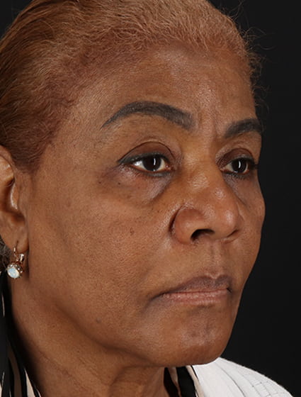 Before - right_oblique