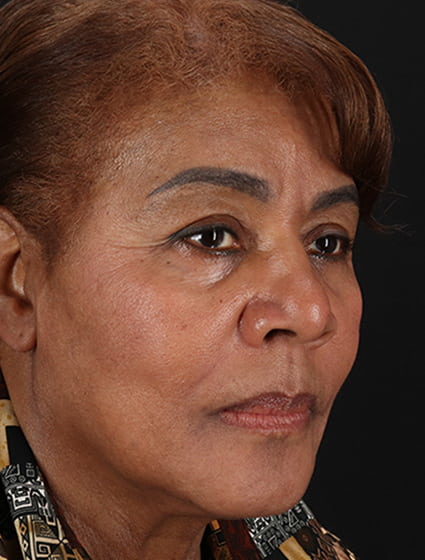 After - right_oblique