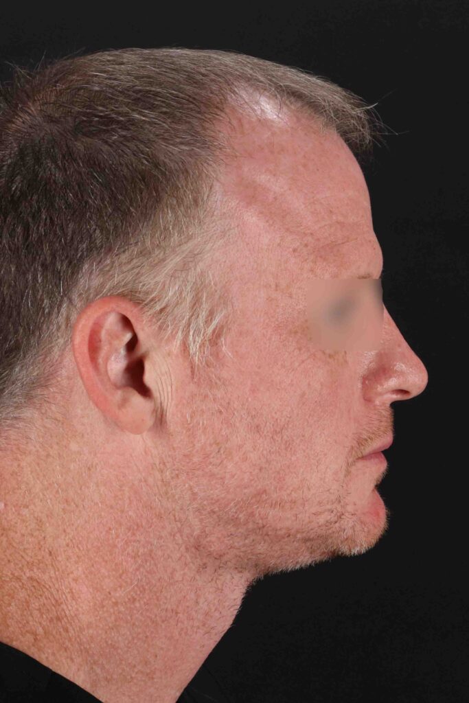 Before - right_lateral