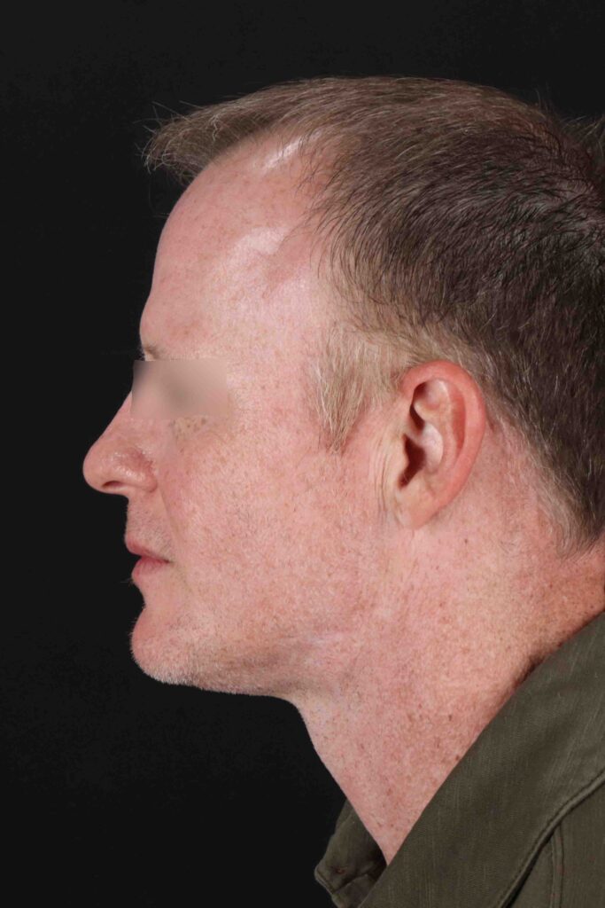 After - left_lateral