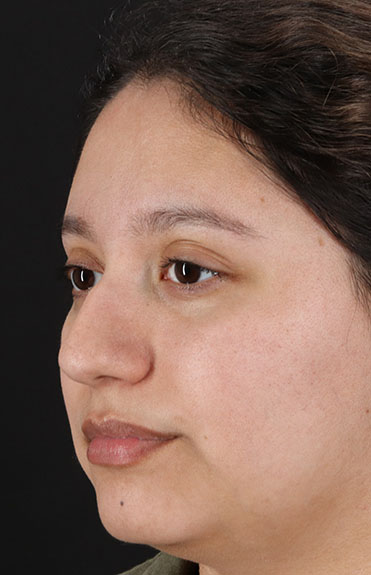 Before - left_oblique