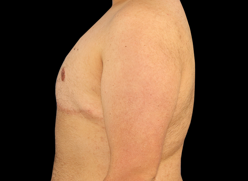 After - left_lateral