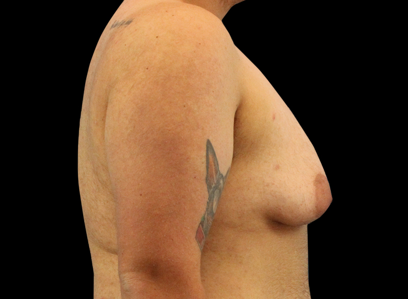 Before - right_lateral