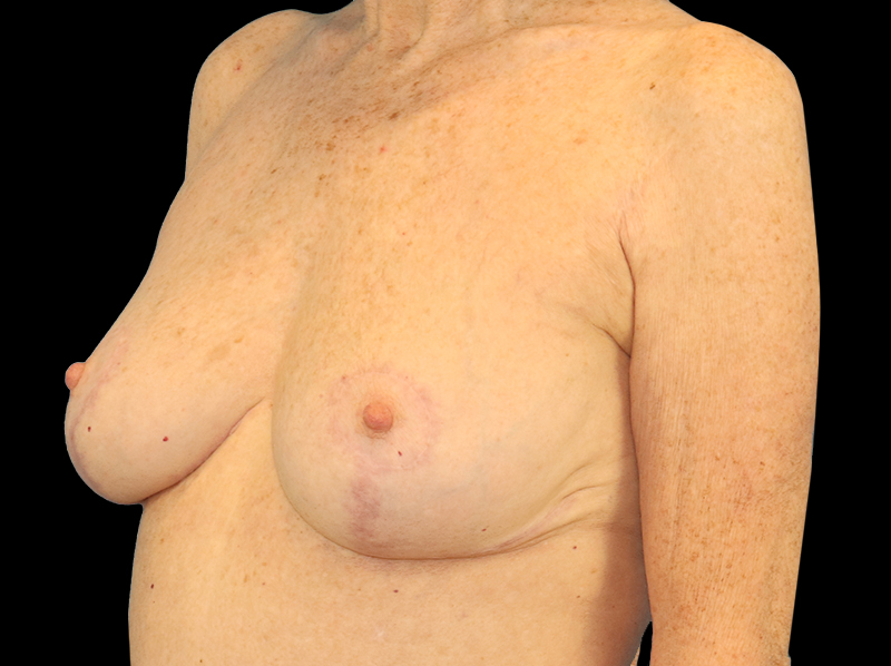 After - left_oblique