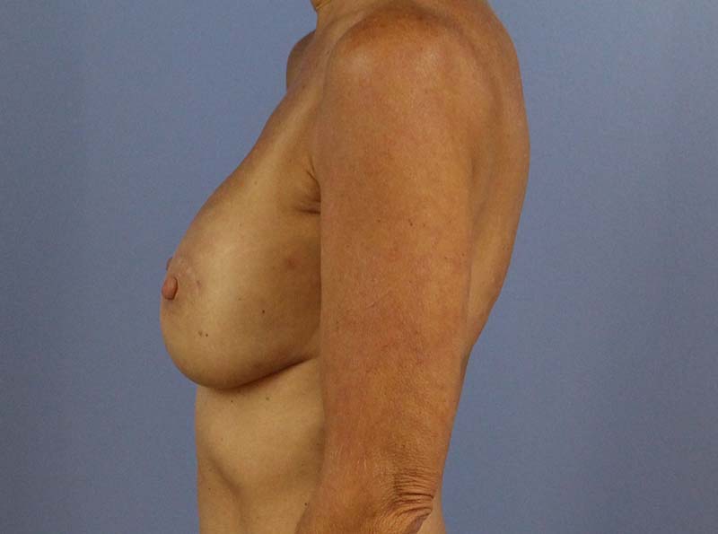 After - left_lateral