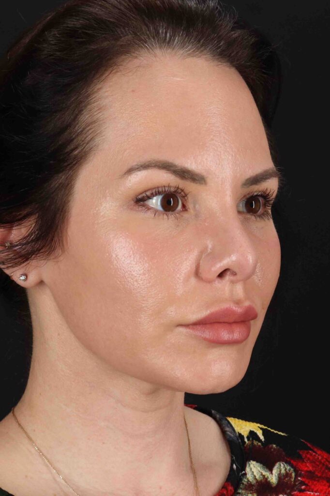 After - right_oblique