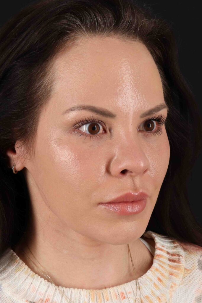 Before - right_oblique