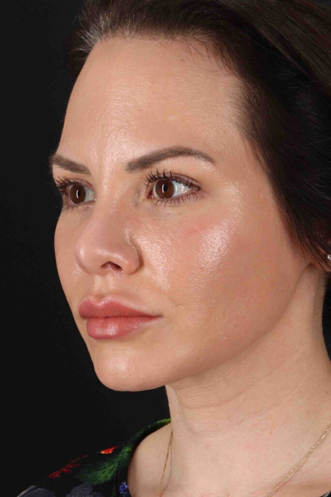 After - left_oblique