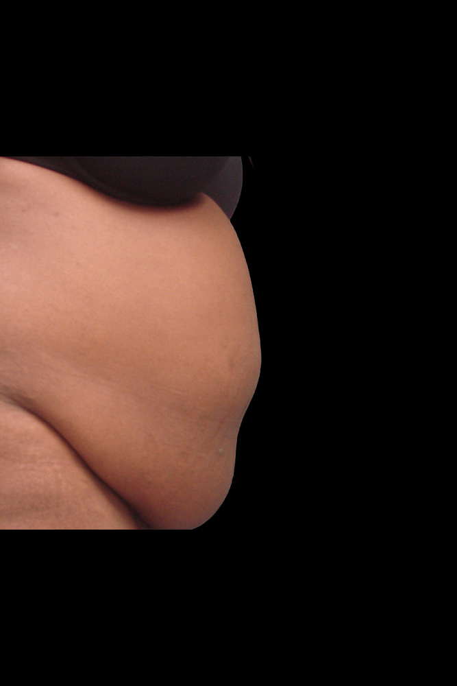 Before - right_lateral