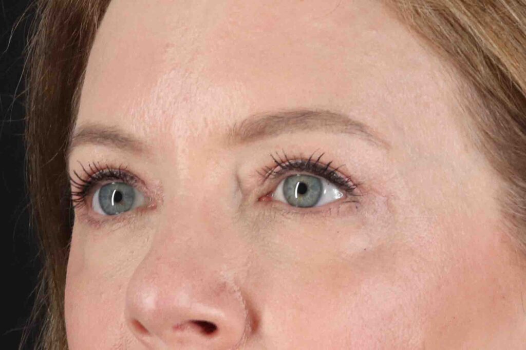 After - left_oblique