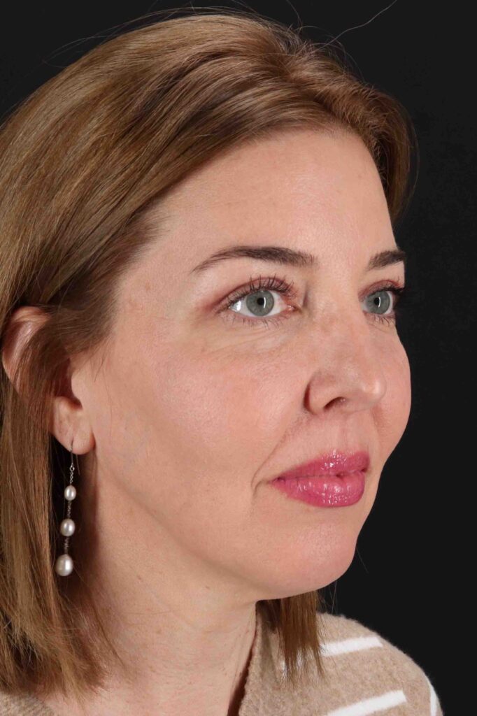 After - right_oblique